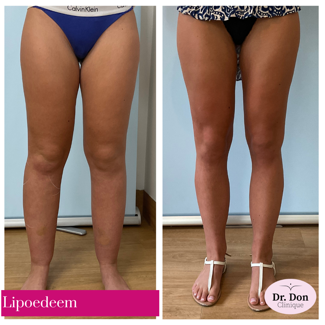 lipoedeem bene clinique dr. don lipoedeem bene clinique dr. don